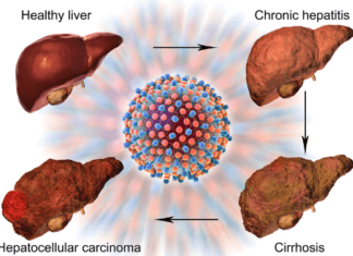 Liver cirrhosis