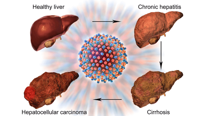 Liver cirrhosis